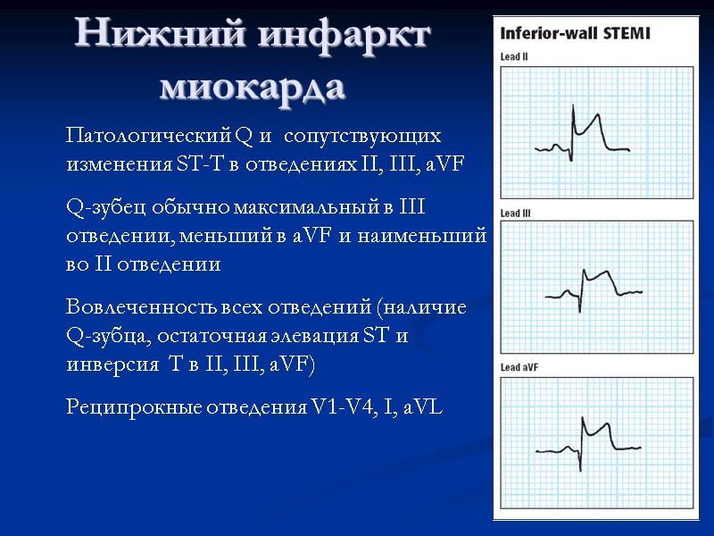Нижний инфаркт миокарда Патологический Q и  сопутствующих изменения ST-T в отведениях II, III,